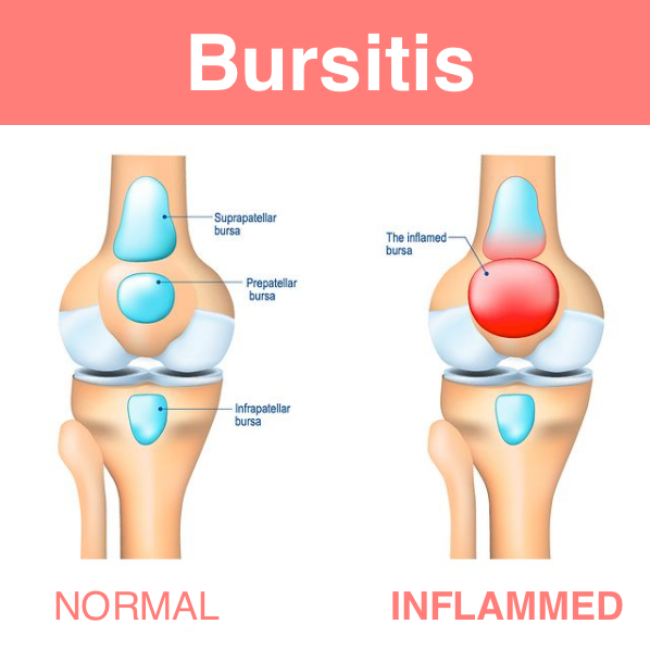 Knee Pain during Physical Activity