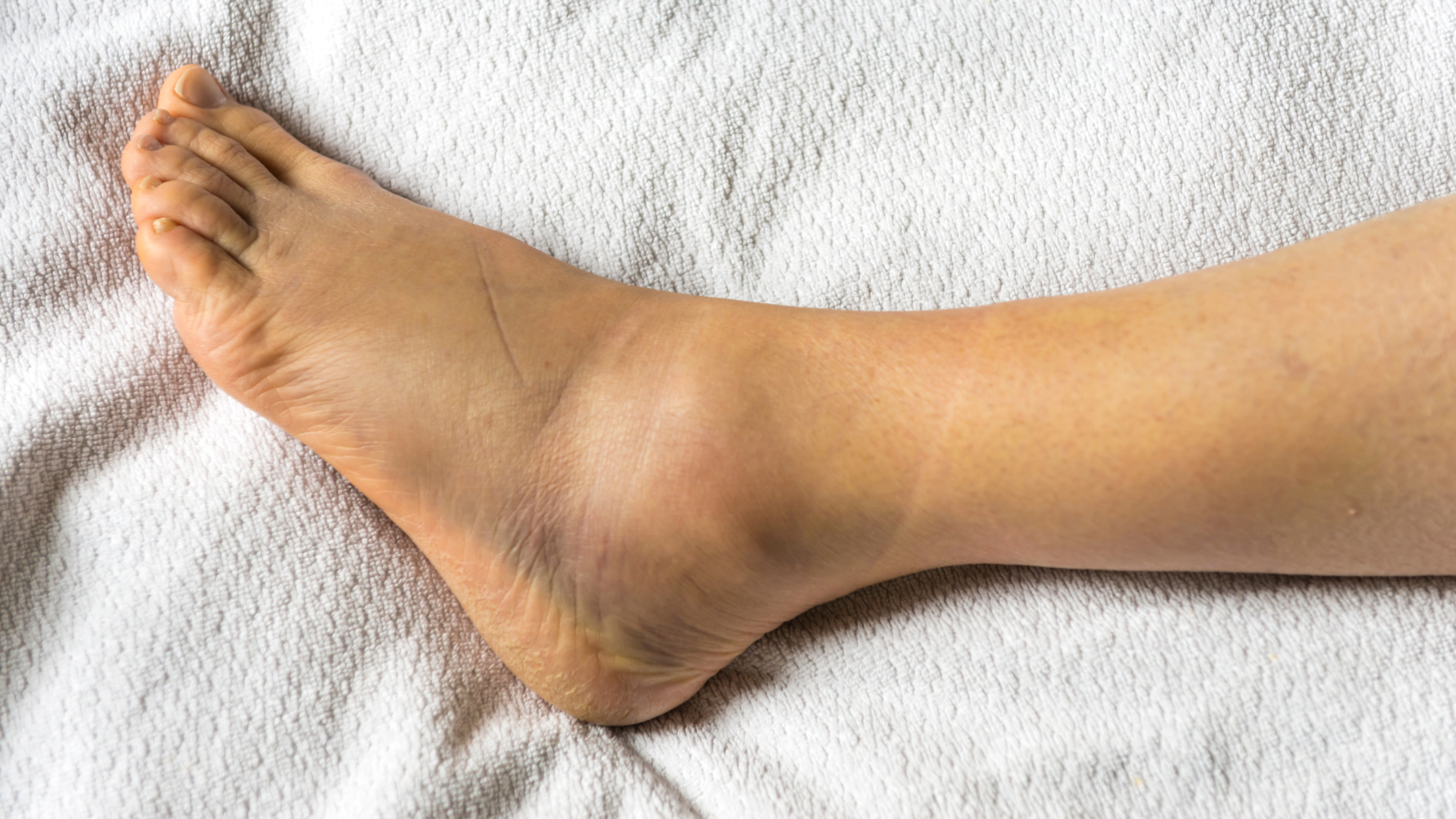 ankle sprains - top 5 tips and tricks